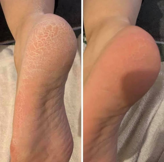 BellaPé - Electric Callus Remover