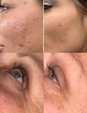 Face Lift™ LED Therapy Mask